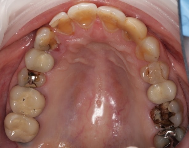 Southington Dentistry | Clenching and Grinding, Plantsville Sixth Month Smiles and Dental Emergencies