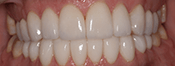 Southington Dentistry | Southington Veneers, Dental Bridges and Clenching and Grinding
