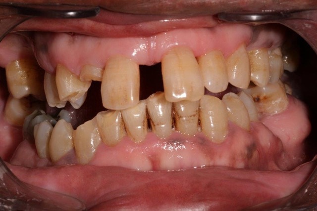 Southington Dentistry | Gum Disease, Drill-Less Dentistry and Jaw Pain/TMJ