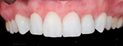 Southington Dentistry | Dental Bridges, Southington Veneers and Dental Crowns