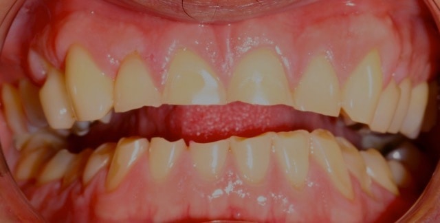 Southington Dentistry | Sedation Dentistry, Southington Veneers and Gum Disease