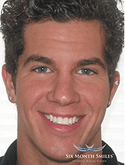 Southington Dentistry | Dental Emergencies, Dental Fillings and Contouring and Bonding