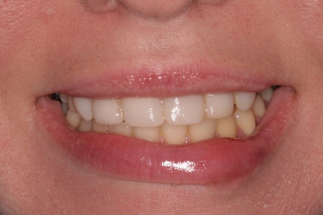 Southington Dentistry | Dental Crowns, Plantsville Dental Implants and Clenching and Grinding