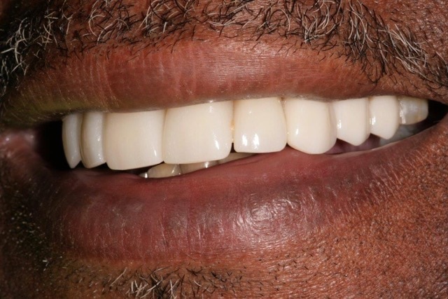 Southington Dentistry | Drill-Less Dentistry, Dentures and Jaw Pain/TMJ