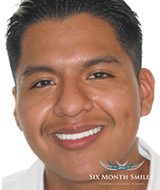 Southington Dentistry | Plantsville Sixth Month Smiles, Drill-Less Dentistry and Dental Fillings