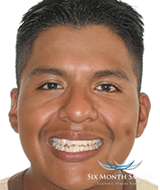 Southington Dentistry | Dentures, Jaw Pain TMJ and Sedation Dentistry