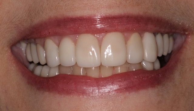 Southington Dentistry | Clenching and Grinding, Family Dentistry in Southington and Root Canals