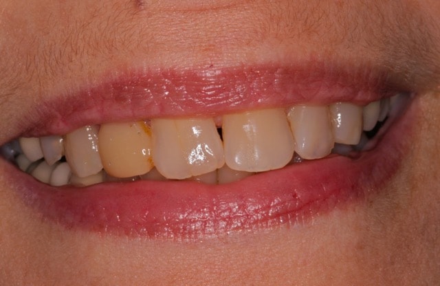 Southington Dentistry | Root Canals, Cosmetic Dentistry and Clenching and Grinding