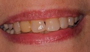 Southington Dentistry | Contouring and Bonding, Plantsville Sixth Month Smiles and Dental Bridges