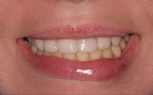 Southington Dentistry | Dental Crowns, Drill-Less Dentistry and Dental Extractions in Southington