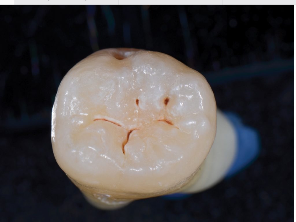 Southington Dentistry | Drill-Less Dentistry, Jaw Pain TMJ and Cosmetic Dentistry