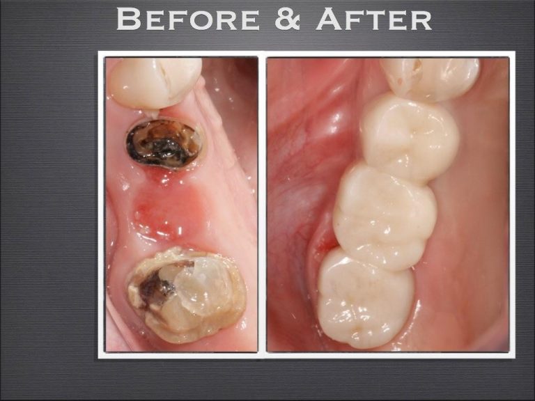 Southington Dentistry | Dental Bridges, Teeth Whitening and Dental Fillings