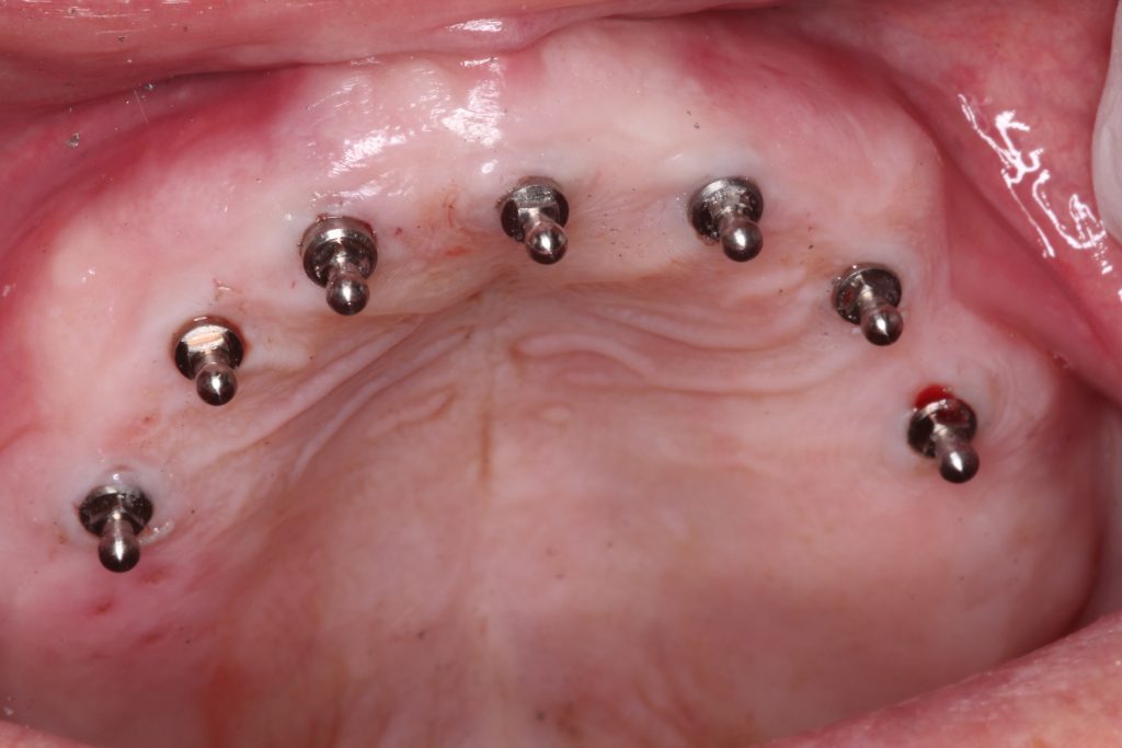 Southington Dentistry | Plantsville Dental Implants, Clenching and Grinding and Jaw Pain/TMJ