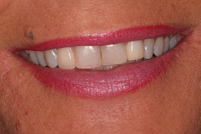 Southington Dentistry | Dental Fillings, Dental Extractions in Southington and Root Canals