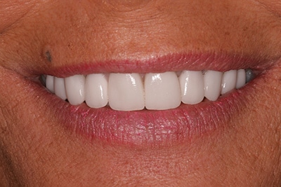 Southington Dentistry | Plantsville Sixth Month Smiles, Dental Fillings and Clenching and Grinding