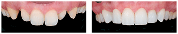 Southington Dentistry | Dental Crowns, Cosmetic Dentistry and Clenching and Grinding