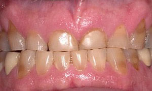 Southington Dentistry | Dentures, Clenching and Grinding and Dental Emergencies