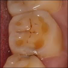 Southington Dentistry | Plantsville Dental Implants, Dental Extractions in Southington and Southington Veneers