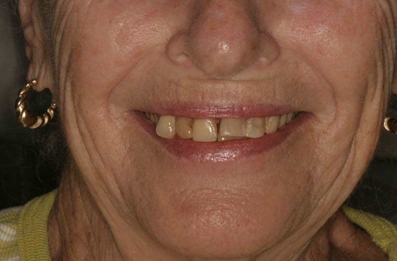 Southington Dentistry | Family Dentistry in Southington, Southington Veneers and Clenching and Grinding