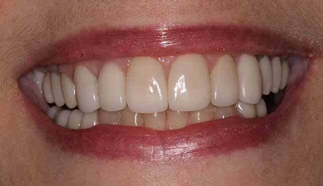 Southington Dentistry | Gum Disease, Jaw Pain TMJ and Dental Crowns