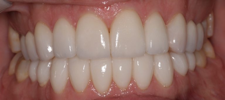 Southington Dentistry | Root Canals, Contouring and Bonding and Dental Emergencies