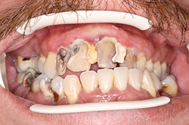 Southington Dentistry | Dental Emergencies, Drill-Less Dentistry and Dental Fillings