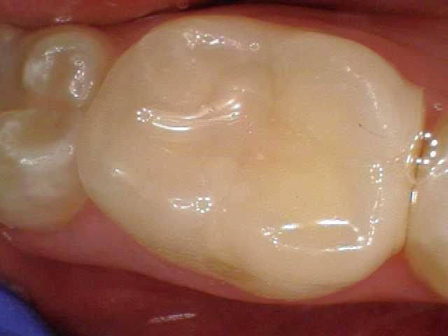 Southington Dentistry | Dental Extractions in Southington, Jaw Pain/TMJ and Teeth Whitening