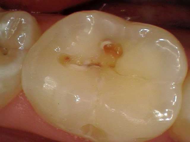 Southington Dentistry | Root Canals, Cosmetic Dentistry and Contouring and Bonding