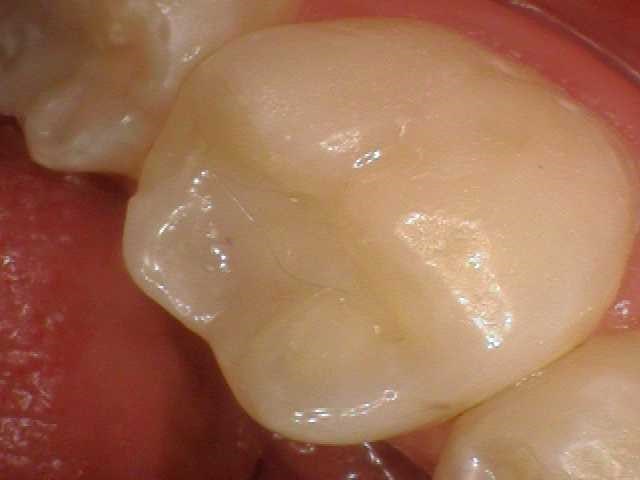 Southington Dentistry | Dental Emergencies, Plantsville Dental Implants and Dental Crowns