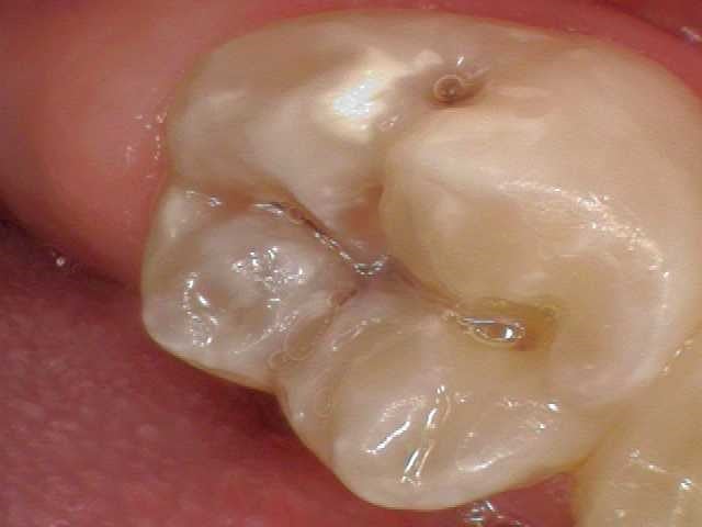 Southington Dentistry | Dental Crowns, Family Dentistry in Southington and Southington Veneers